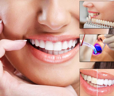 Laser-Assisted Root Canal Therapys